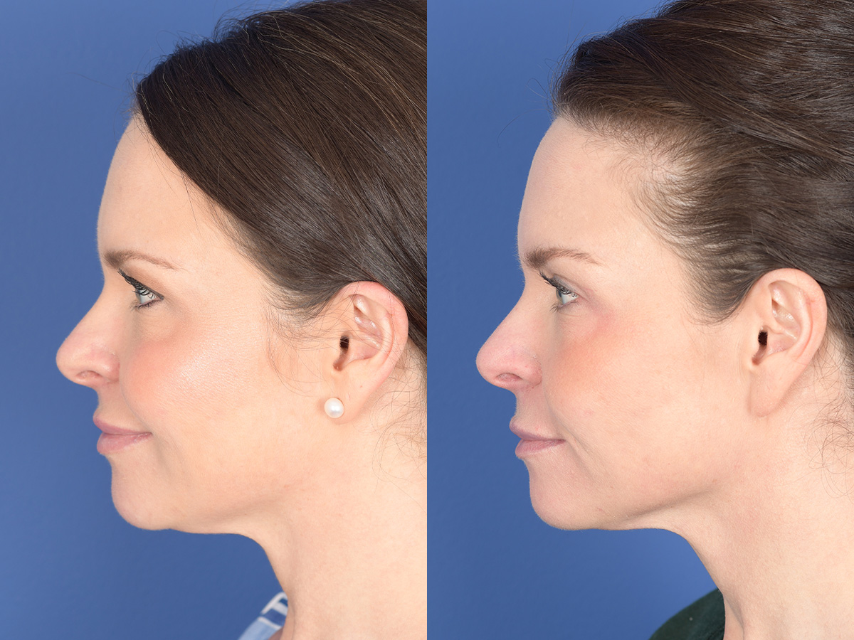 Blepharoplasty Before and After | Weber Facial Plastic Surgery