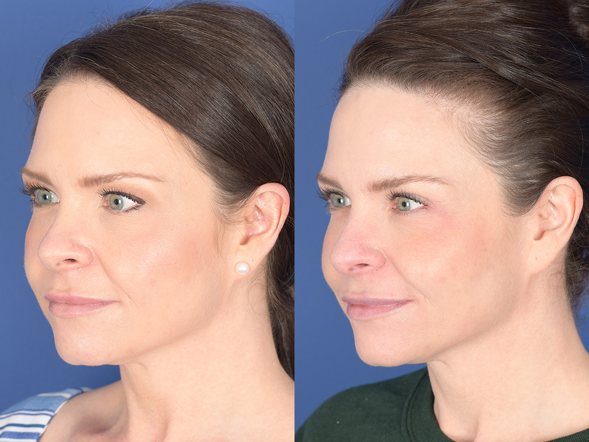 Blepharoplasty Before and After | Weber Facial Plastic Surgery