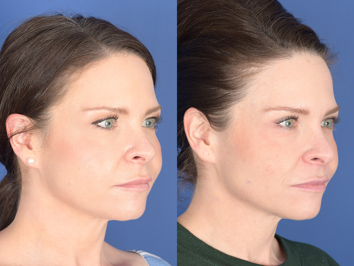 Blepharoplasty Before and After | Weber Facial Plastic Surgery