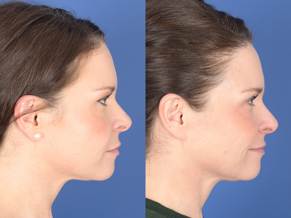 Blepharoplasty Before and After | Weber Facial Plastic Surgery