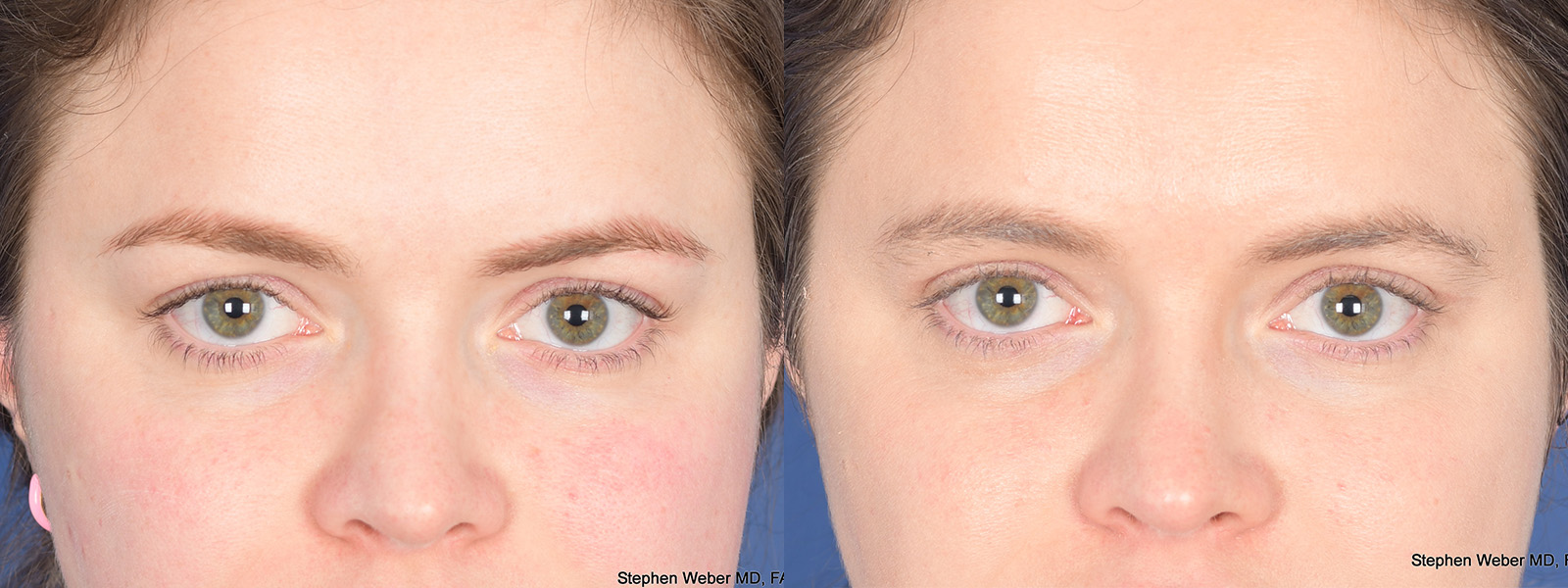 Blepharoplasty Before and After | Weber Facial Plastic Surgery