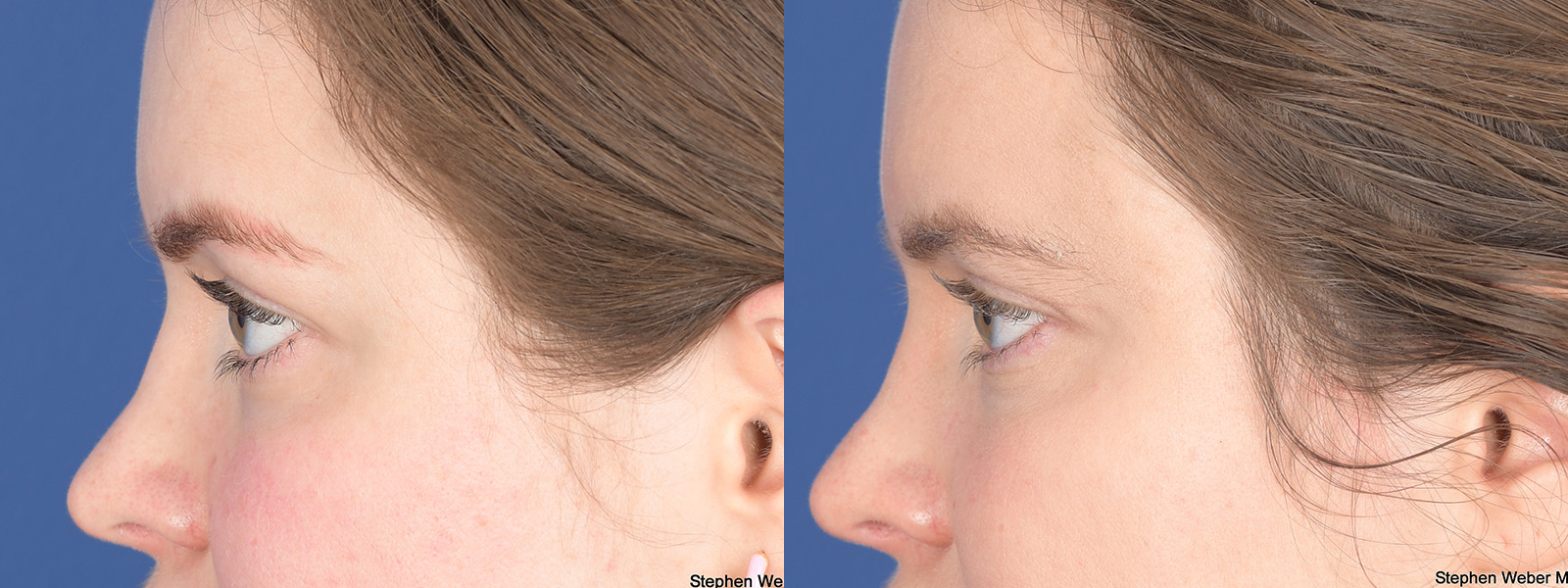 Blepharoplasty Before and After | Weber Facial Plastic Surgery