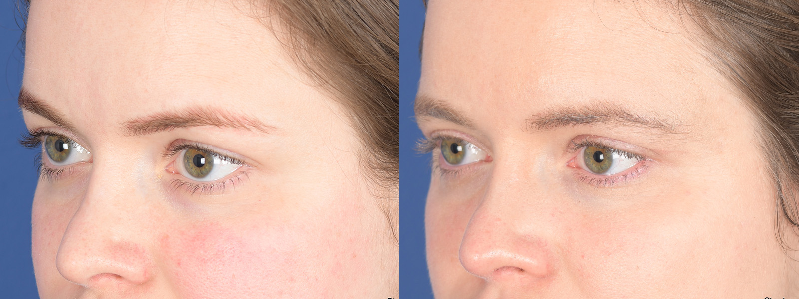 Blepharoplasty Before and After | Weber Facial Plastic Surgery