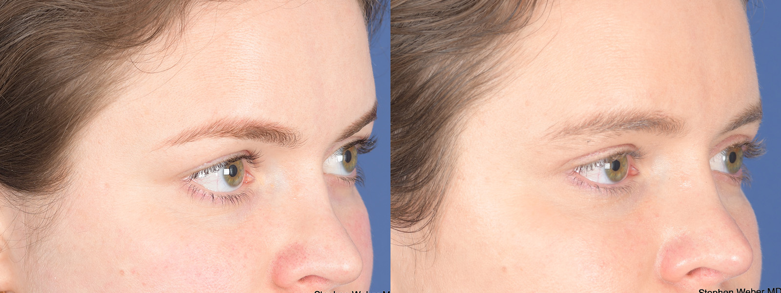 Blepharoplasty Before and After | Weber Facial Plastic Surgery