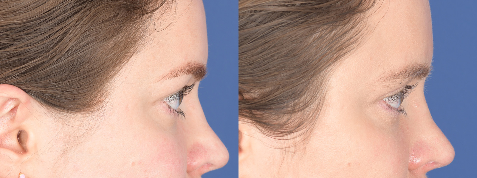 Blepharoplasty Before and After | Weber Facial Plastic Surgery