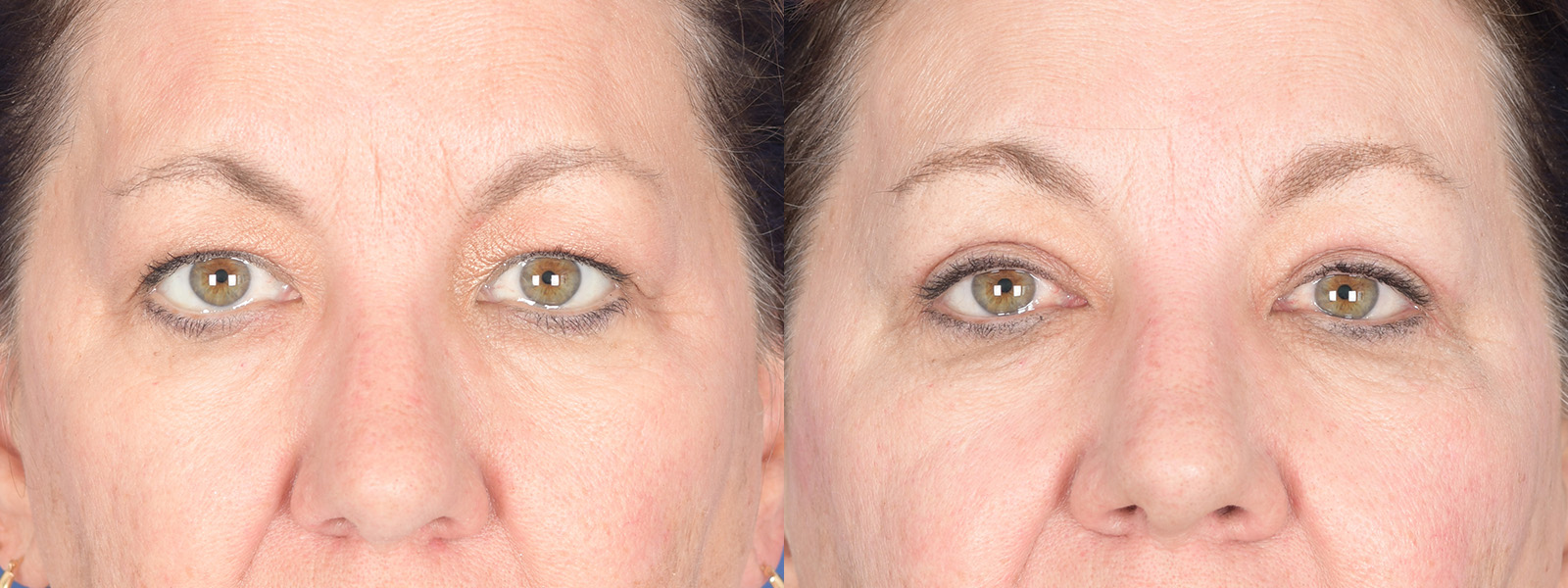 Blepharoplasty Before and After | Weber Facial Plastic Surgery
