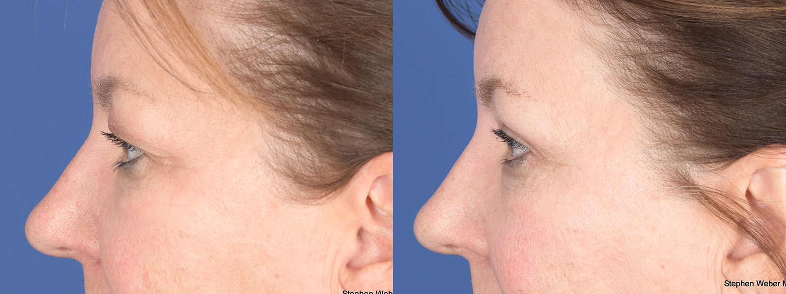 Blepharoplasty Before and After | Weber Facial Plastic Surgery