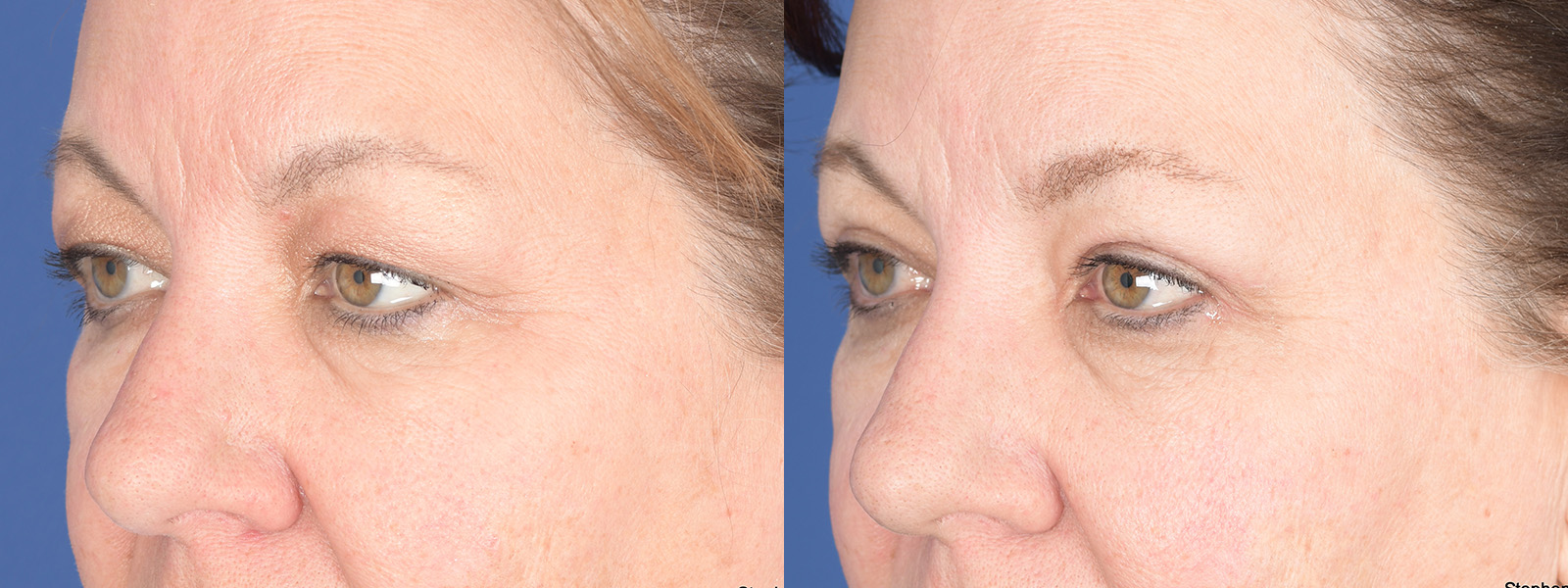 Blepharoplasty Before and After | Weber Facial Plastic Surgery