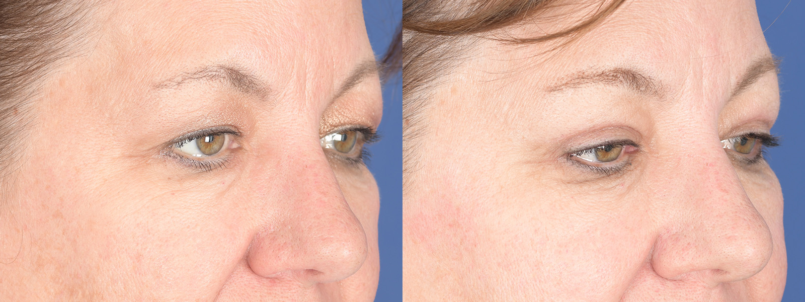 Blepharoplasty Before and After | Weber Facial Plastic Surgery