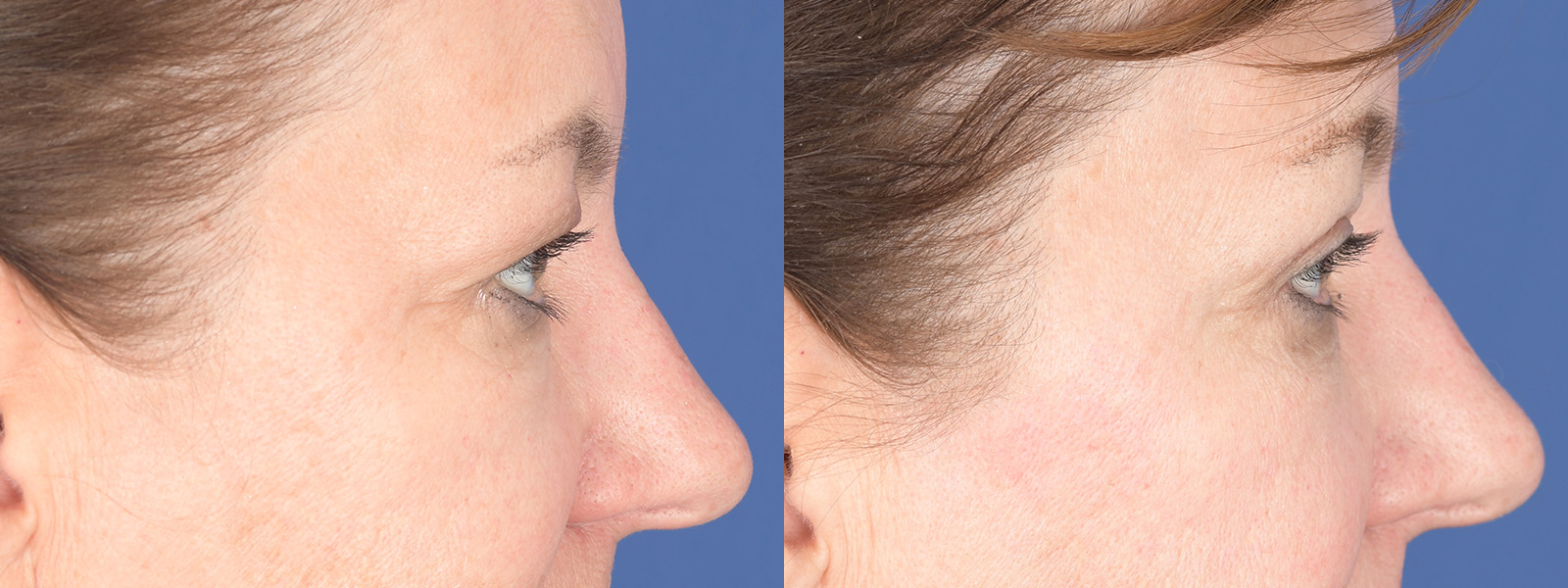 Blepharoplasty Before and After | Weber Facial Plastic Surgery