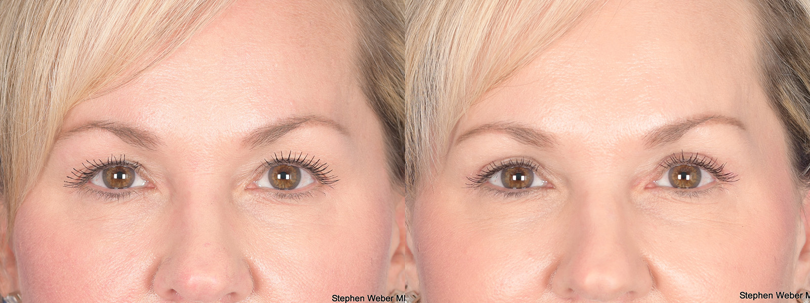 Blepharoplasty Before and After | Weber Facial Plastic Surgery