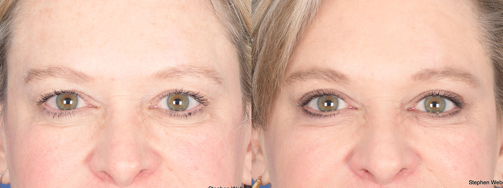 Blepharoplasty Before and After | Weber Facial Plastic Surgery