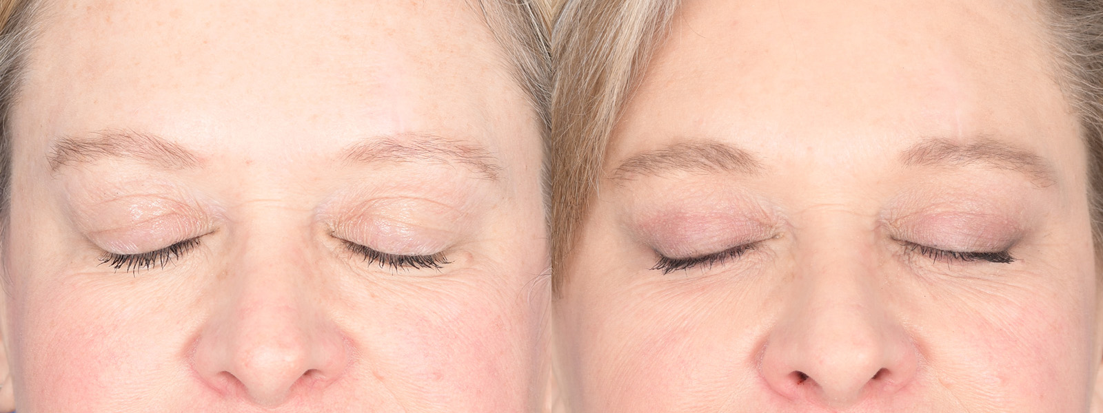 Blepharoplasty Before and After | Weber Facial Plastic Surgery