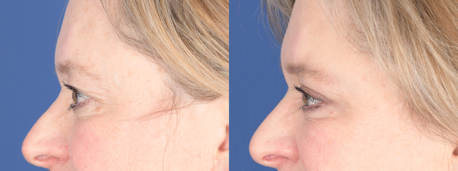 Blepharoplasty Before and After | Weber Facial Plastic Surgery