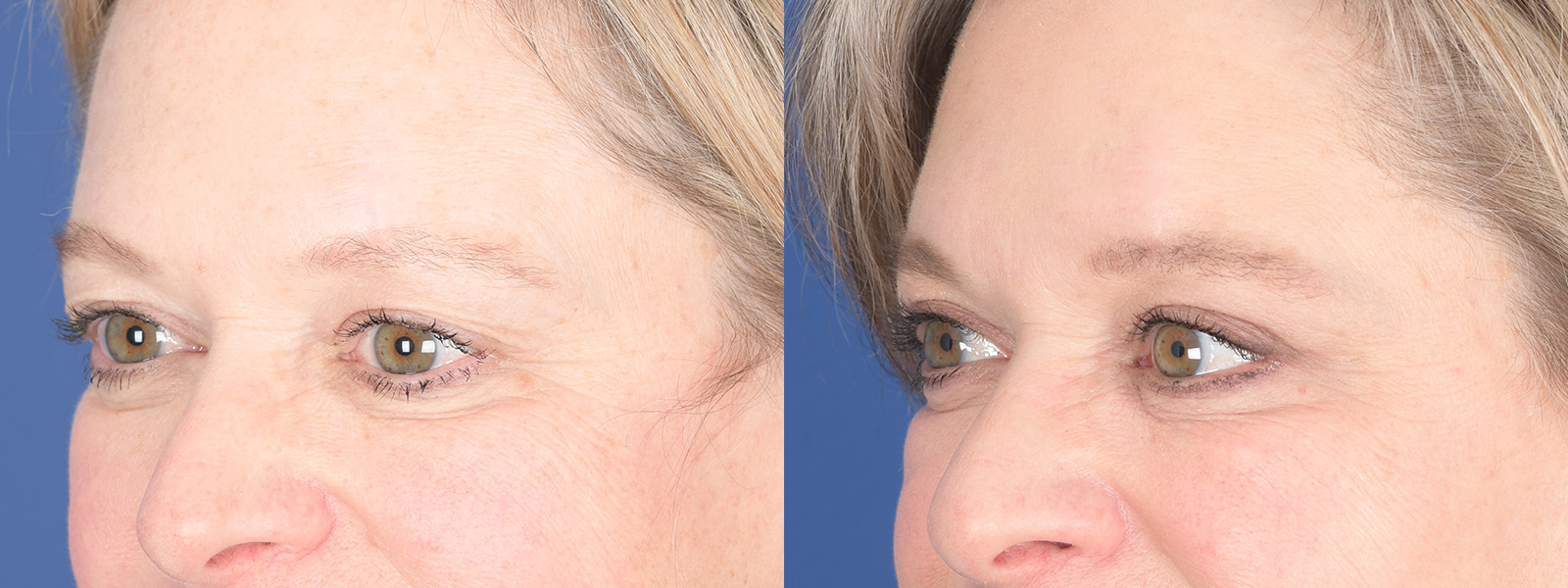 Blepharoplasty Before and After | Weber Facial Plastic Surgery