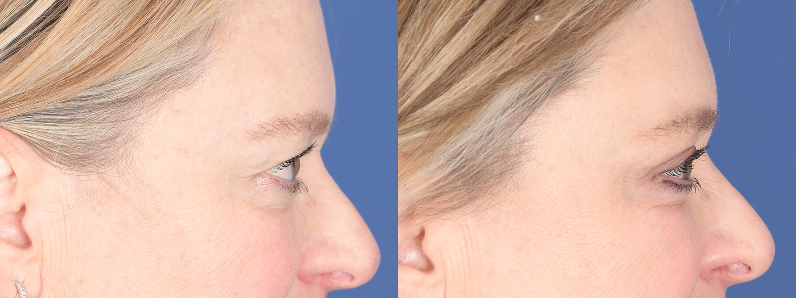 Blepharoplasty Before and After | Weber Facial Plastic Surgery
