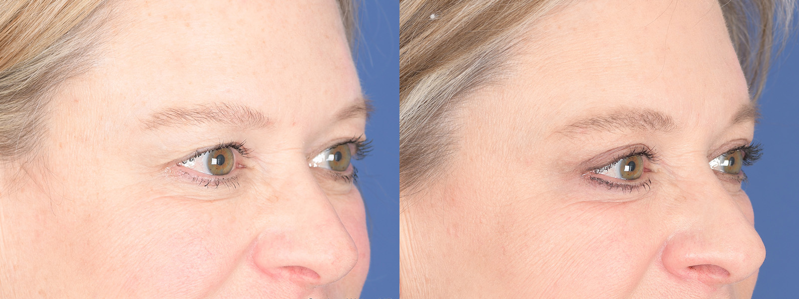 Blepharoplasty Before and After | Weber Facial Plastic Surgery