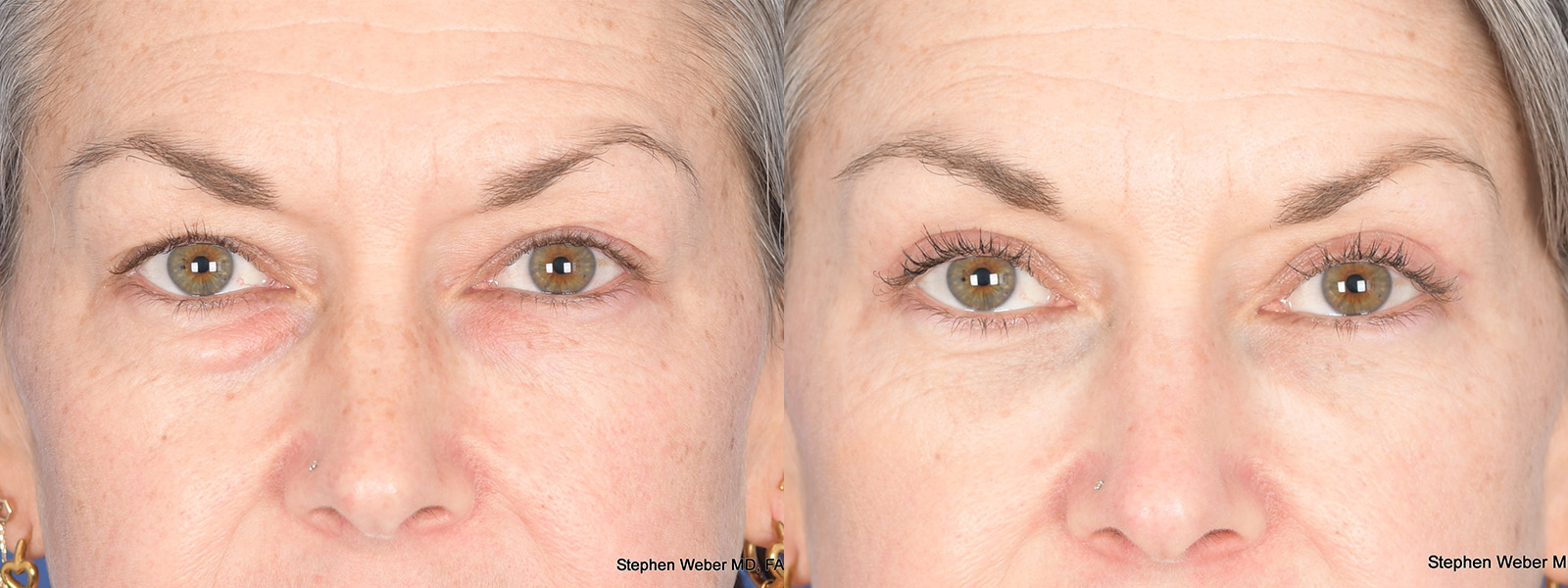 Blepharoplasty Before and After | Weber Facial Plastic Surgery