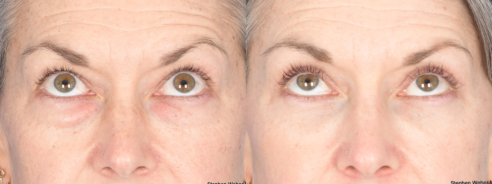 Blepharoplasty Before and After | Weber Facial Plastic Surgery