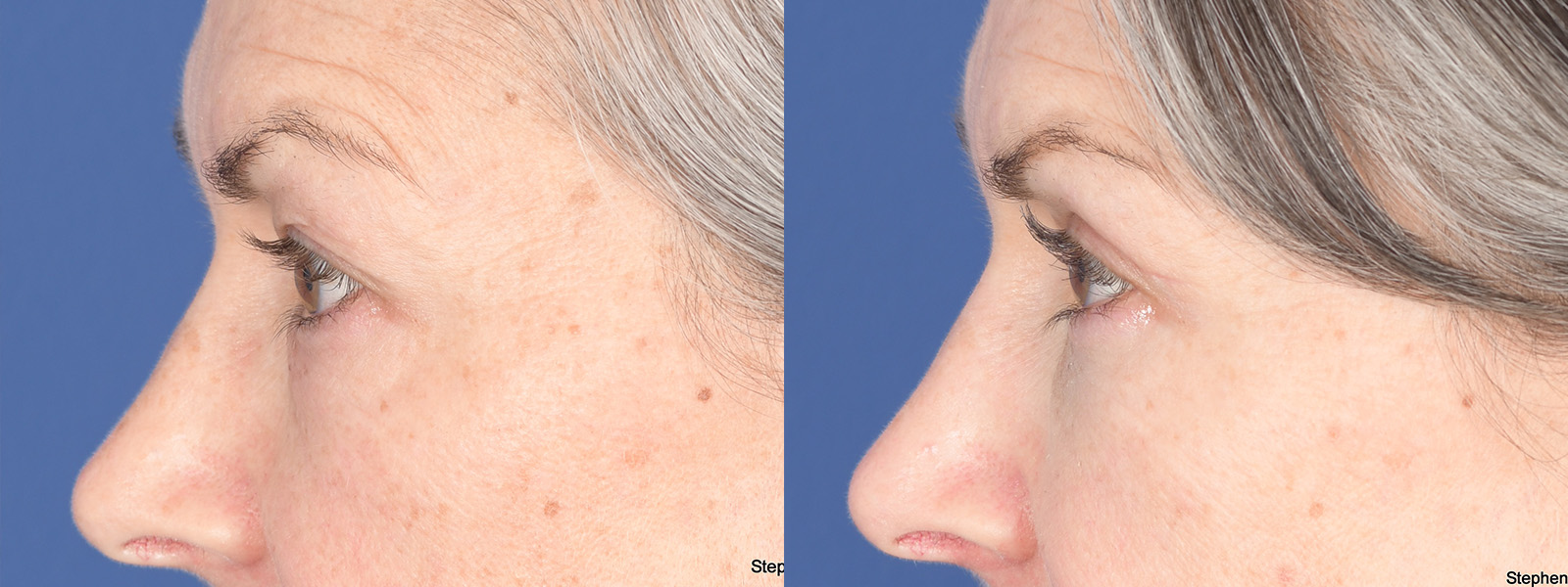 Blepharoplasty Before and After | Weber Facial Plastic Surgery