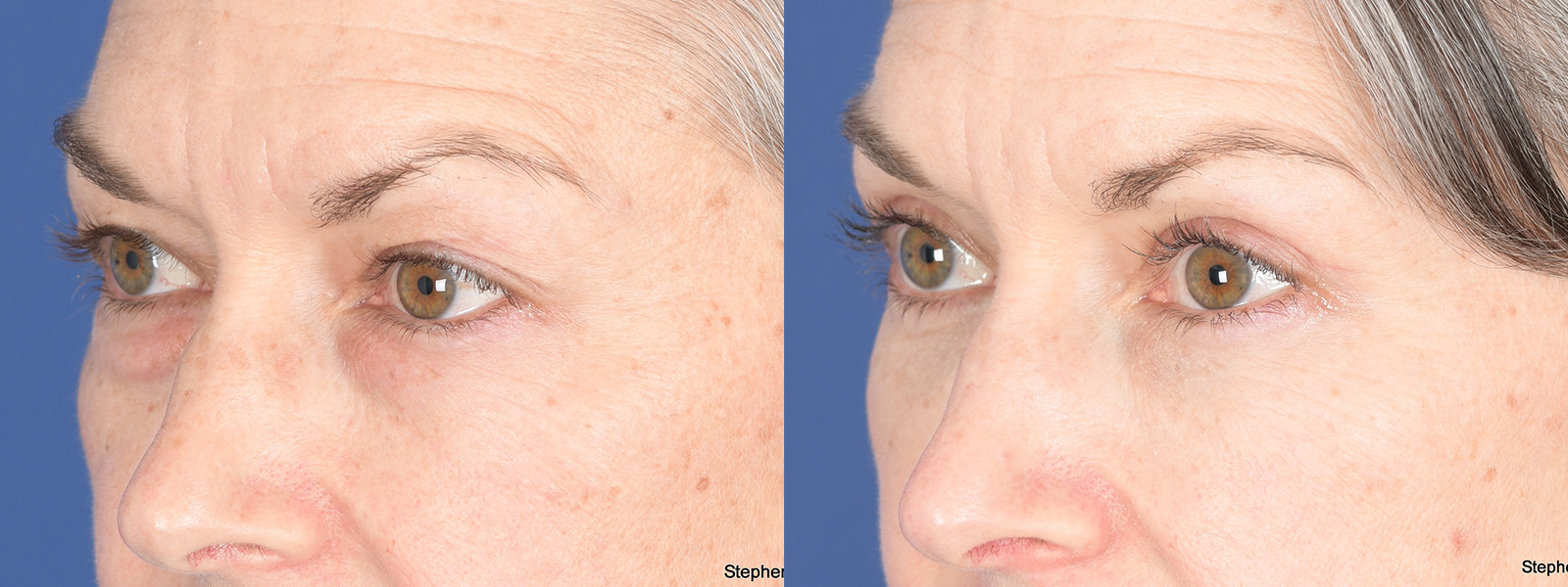 Blepharoplasty Before and After | Weber Facial Plastic Surgery