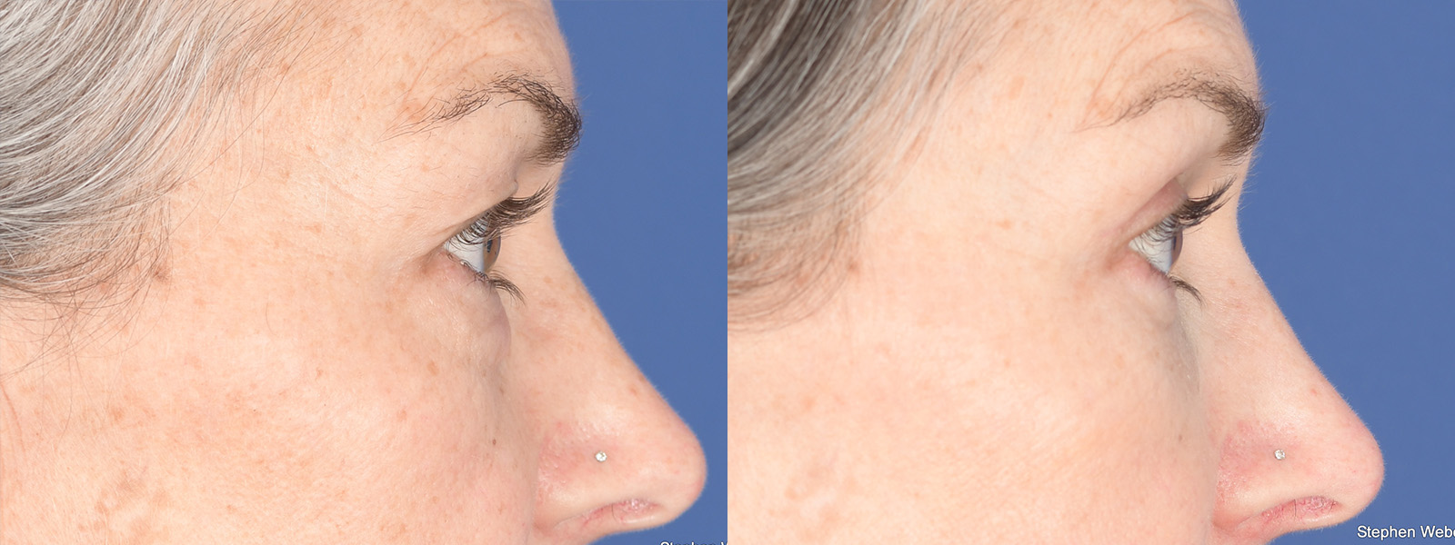 Blepharoplasty Before and After | Weber Facial Plastic Surgery