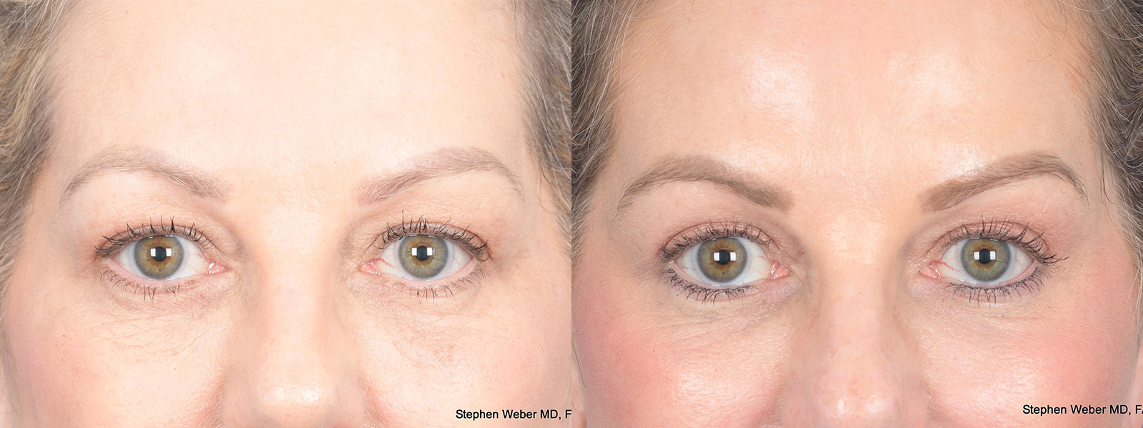 Blepharoplasty Before and After | Weber Facial Plastic Surgery