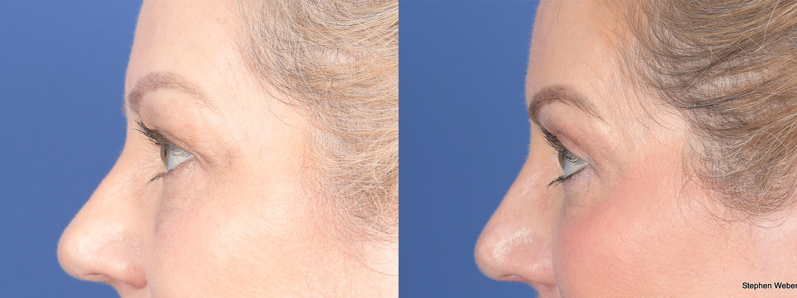 Blepharoplasty Before and After | Weber Facial Plastic Surgery