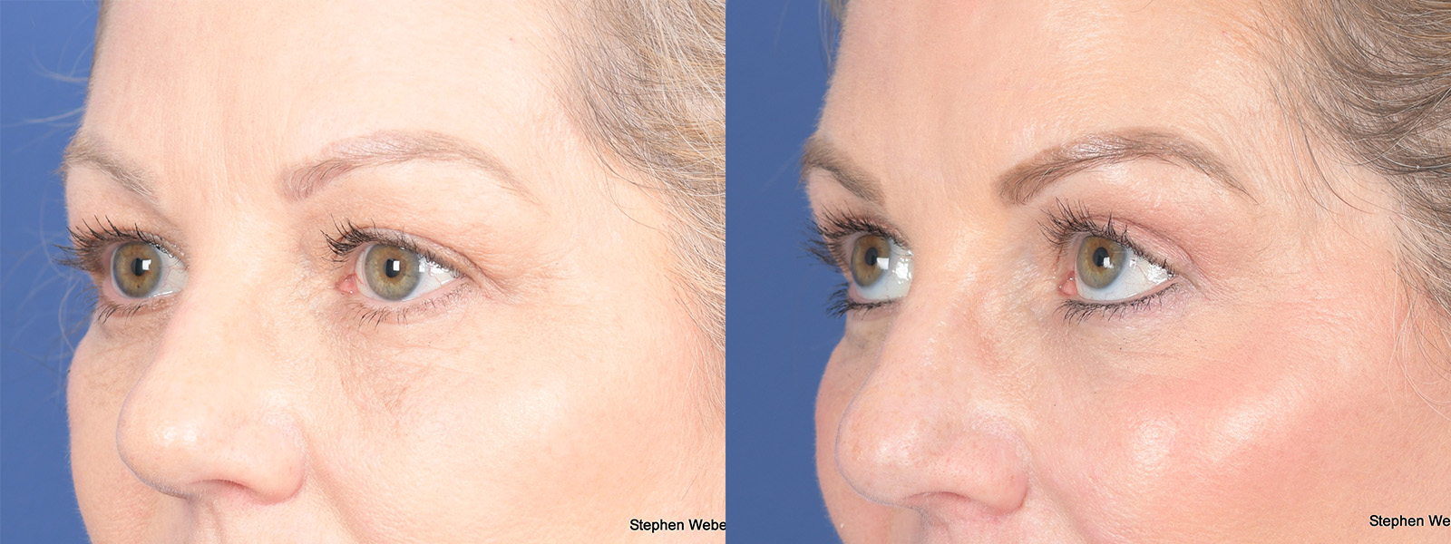 Blepharoplasty Before and After | Weber Facial Plastic Surgery
