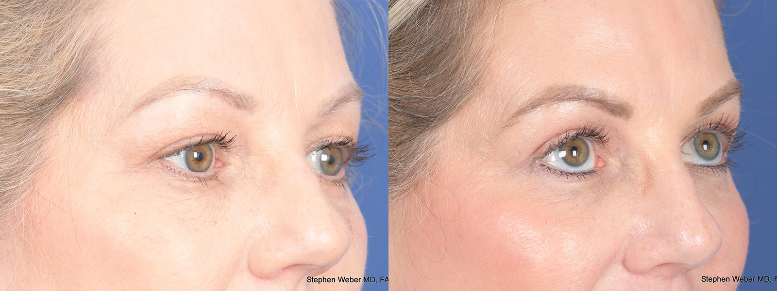 Blepharoplasty Before and After | Weber Facial Plastic Surgery