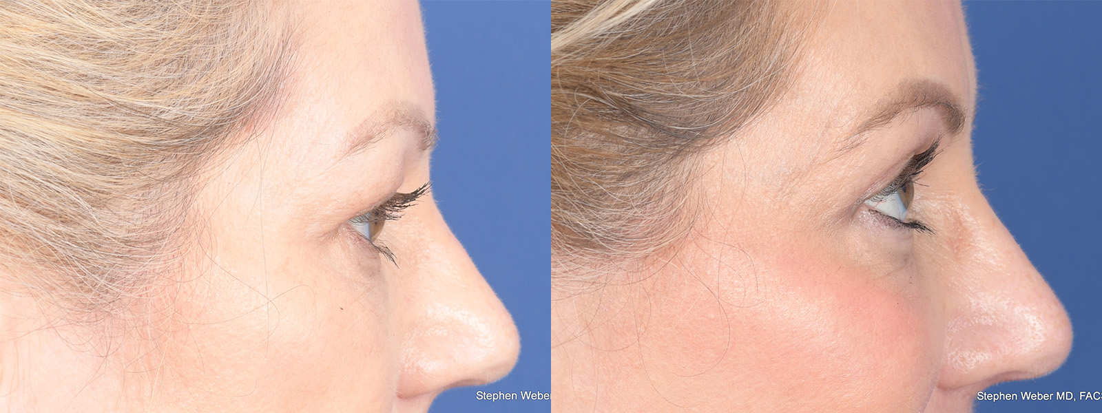 Blepharoplasty Before and After | Weber Facial Plastic Surgery