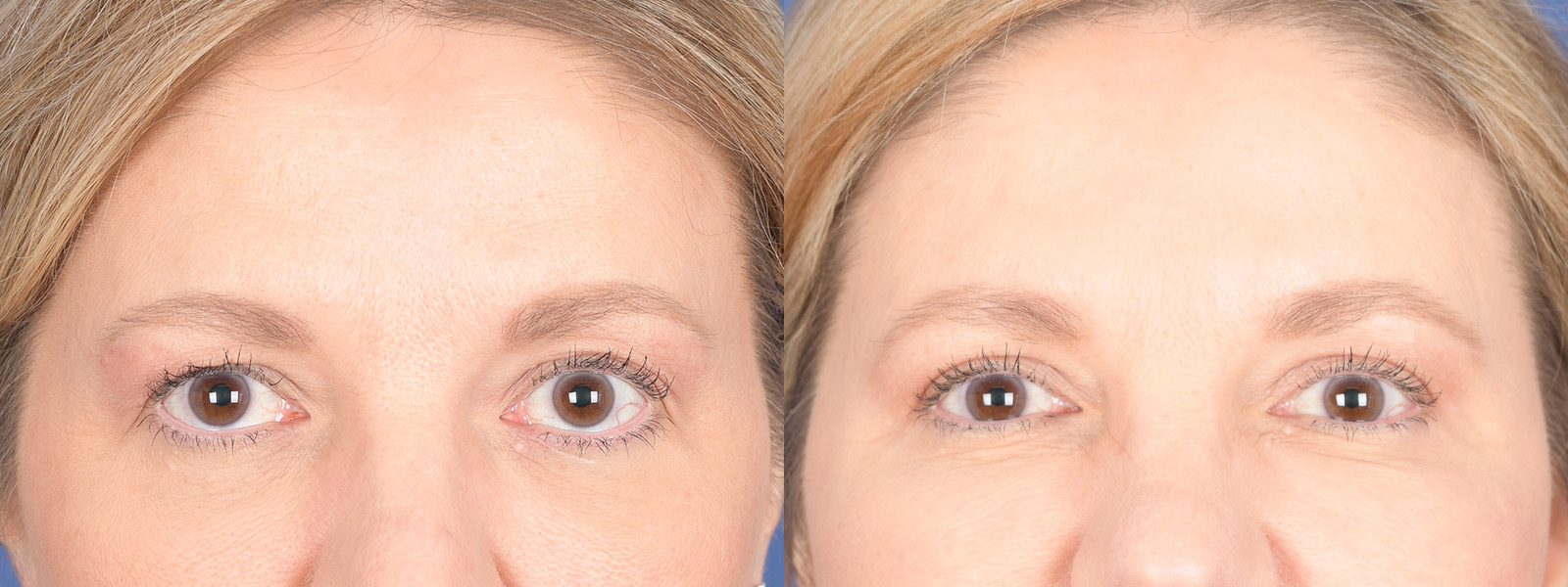 Blepharoplasty Before and After | Weber Facial Plastic Surgery