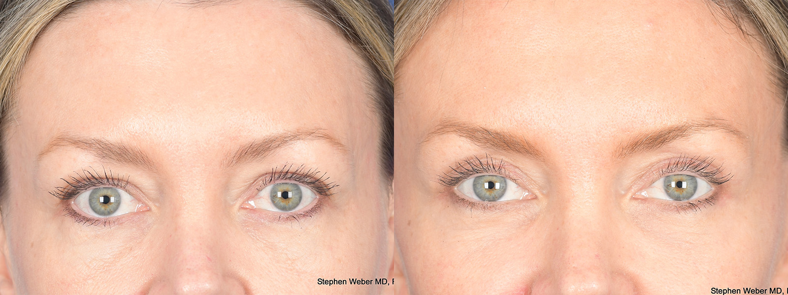 Blepharoplasty Before and After | Weber Facial Plastic Surgery