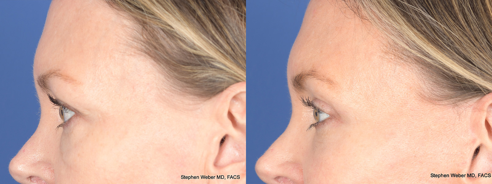 Blepharoplasty Before and After | Weber Facial Plastic Surgery