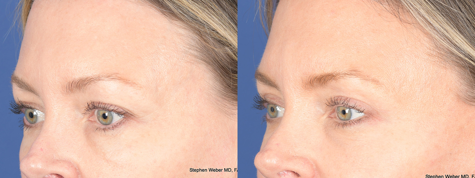 Blepharoplasty Before and After | Weber Facial Plastic Surgery