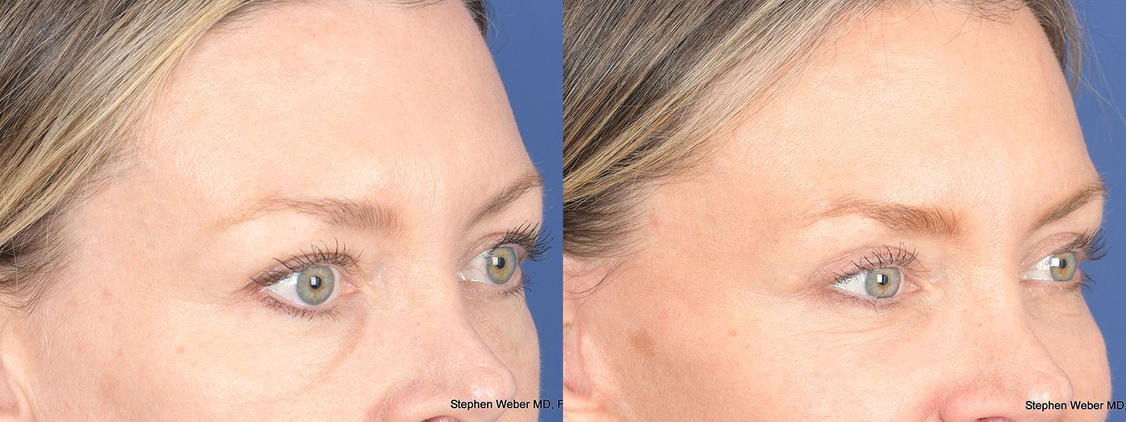 Blepharoplasty Before and After | Weber Facial Plastic Surgery