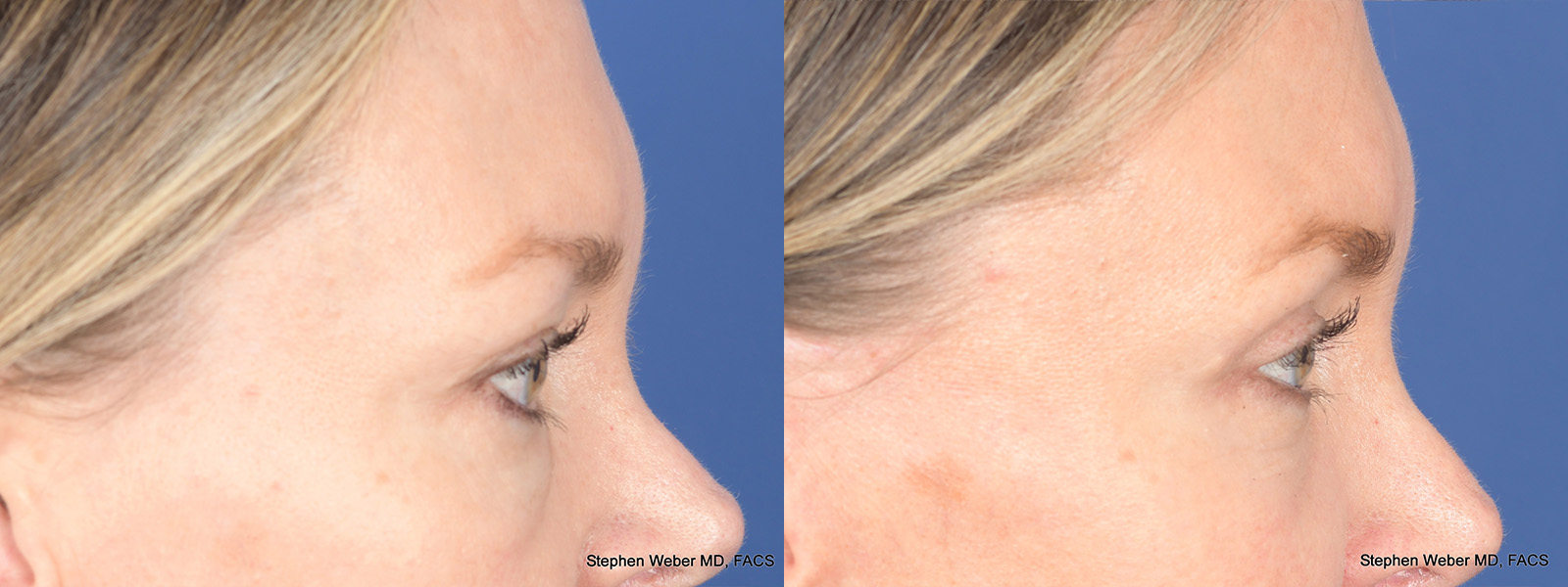 Blepharoplasty Before and After | Weber Facial Plastic Surgery
