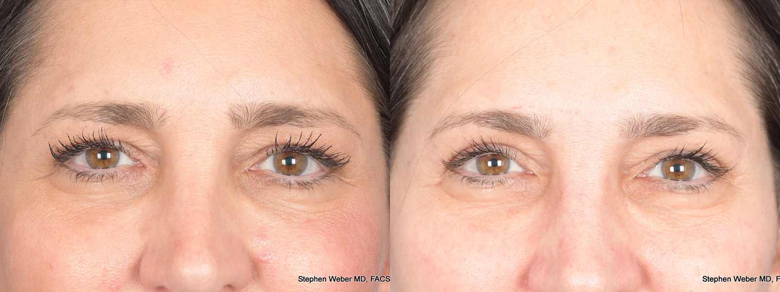 Blepharoplasty Before and After | Weber Facial Plastic Surgery