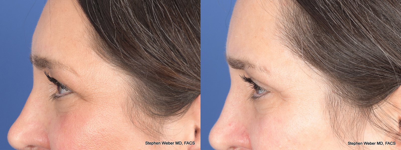 Blepharoplasty Before and After | Weber Facial Plastic Surgery