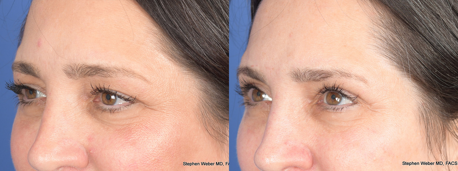 Blepharoplasty Before and After | Weber Facial Plastic Surgery