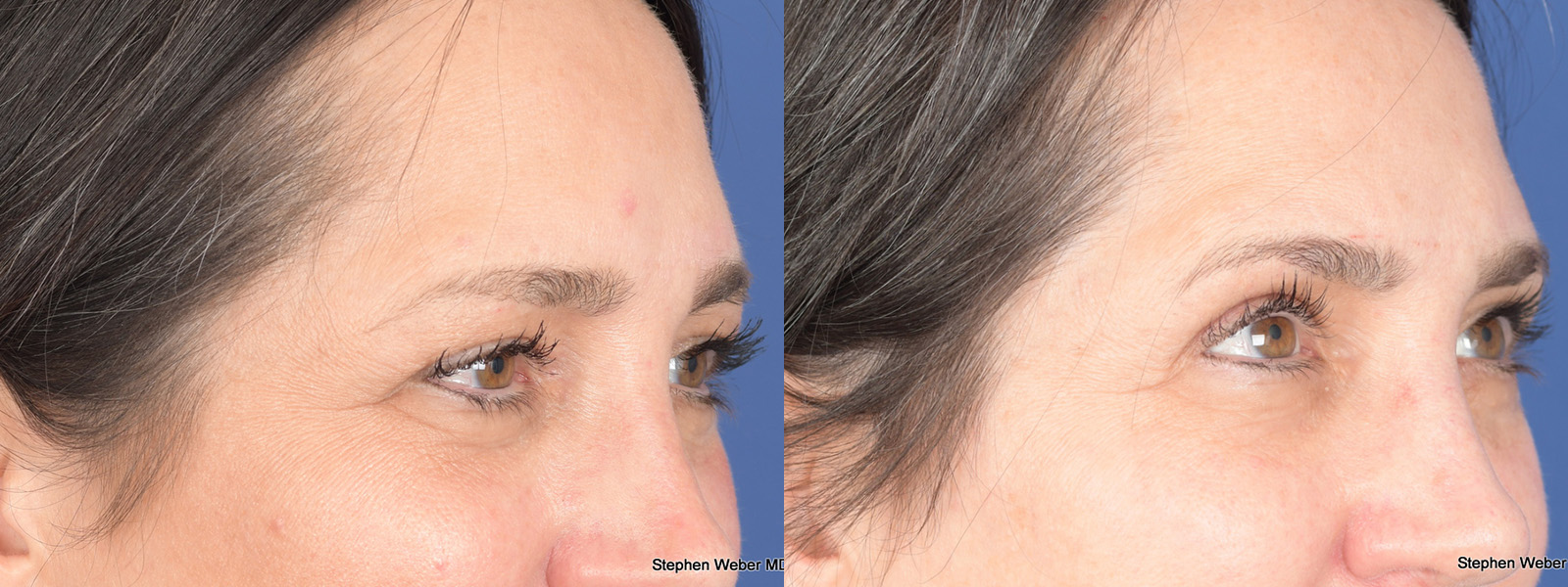 Blepharoplasty Before and After | Weber Facial Plastic Surgery