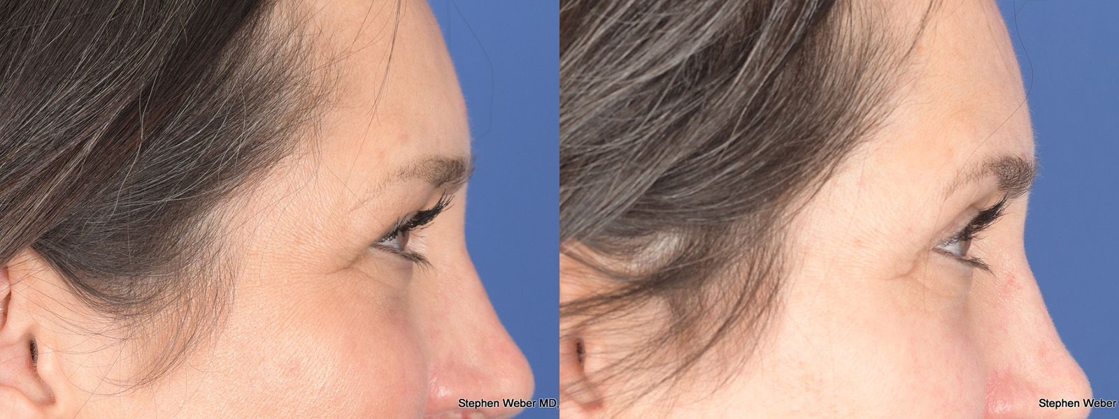 Blepharoplasty Before and After | Weber Facial Plastic Surgery