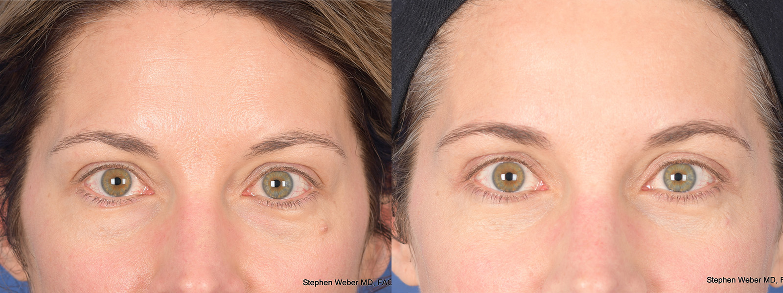 Before and After Eyelid Surgery in Denver 1