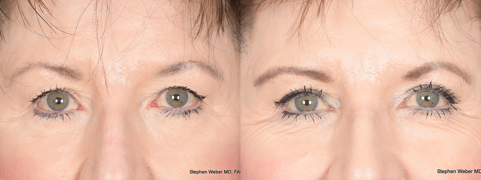 Blepharoplasty Before and After | Weber Facial Plastic Surgery