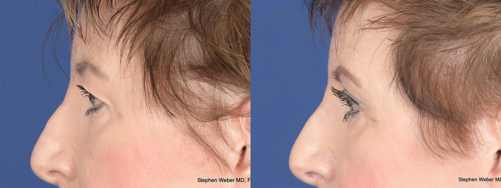 Blepharoplasty Before and After | Weber Facial Plastic Surgery