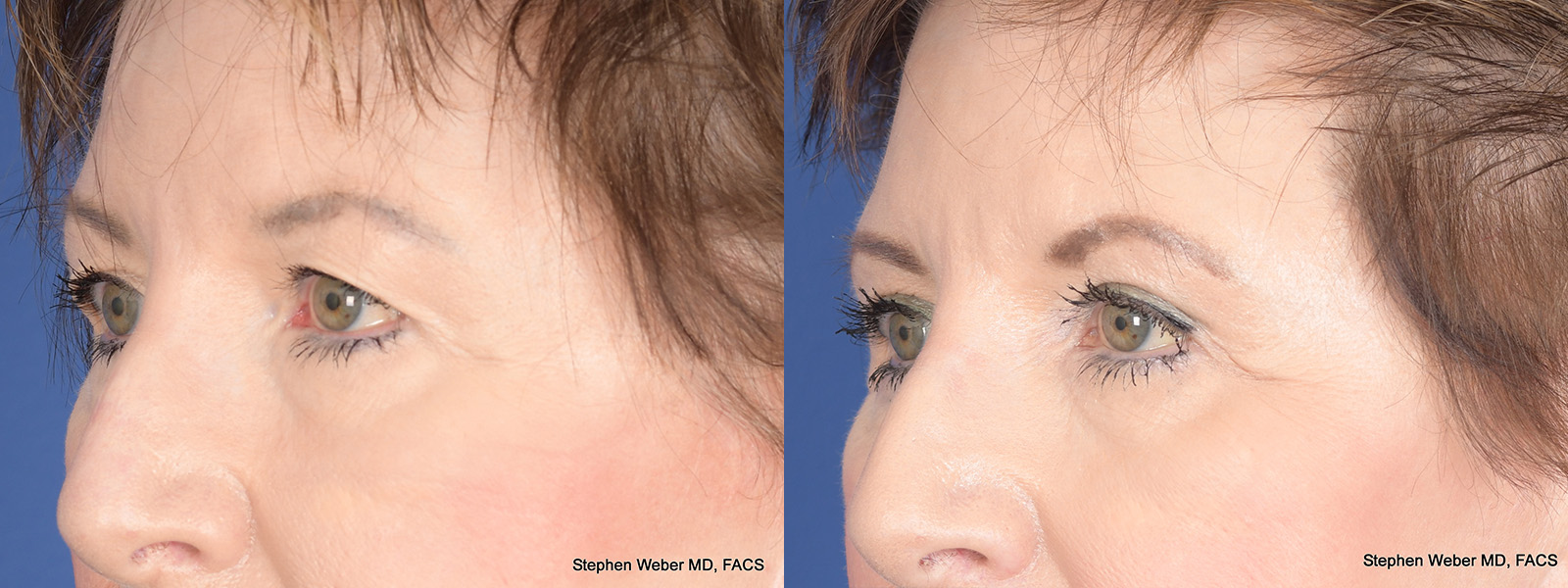 Blepharoplasty Before and After | Weber Facial Plastic Surgery