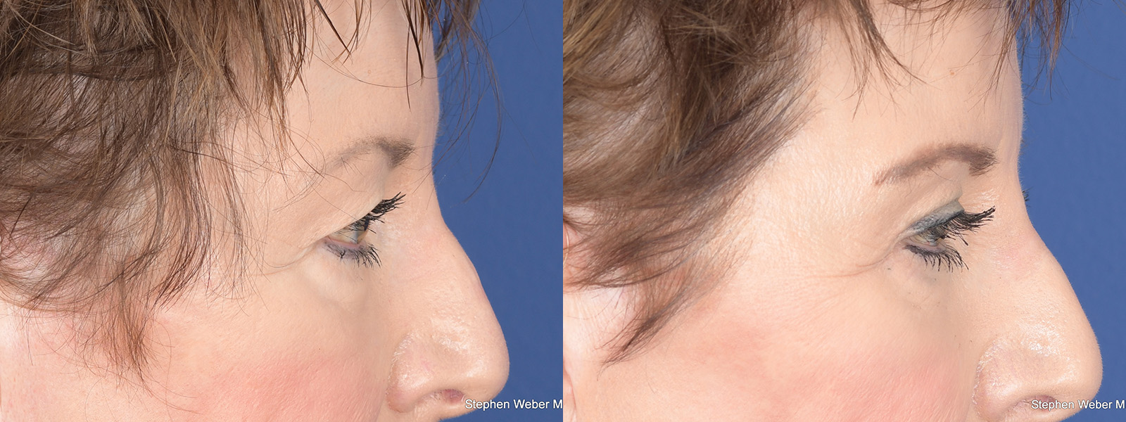 Blepharoplasty Before and After | Weber Facial Plastic Surgery