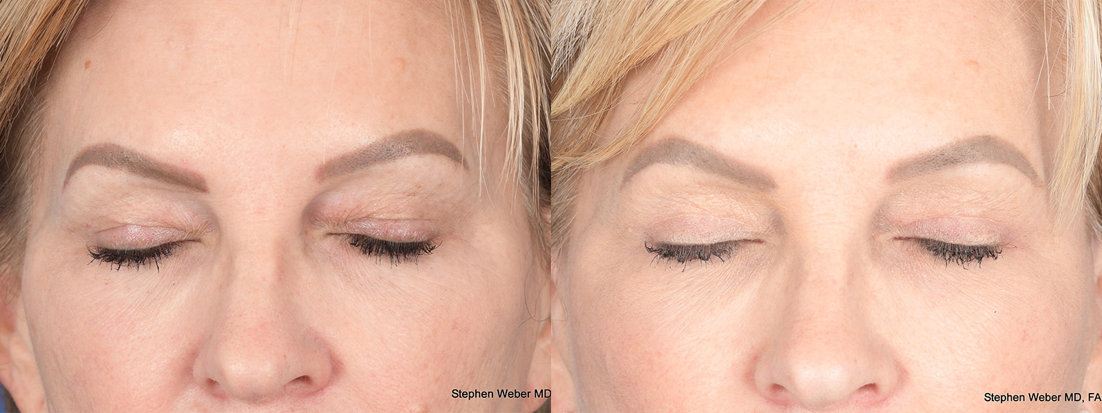 Blepharoplasty Before and After | Weber Facial Plastic Surgery