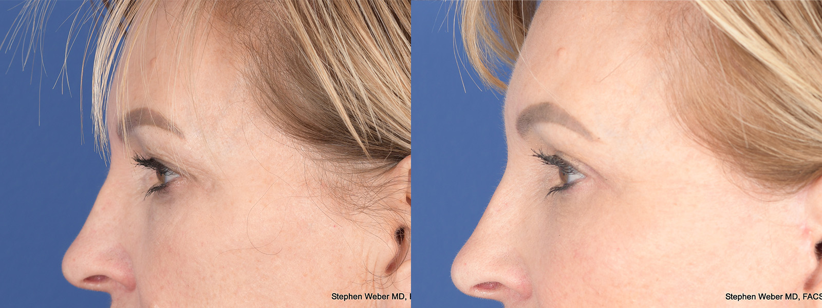 Blepharoplasty Before and After | Weber Facial Plastic Surgery