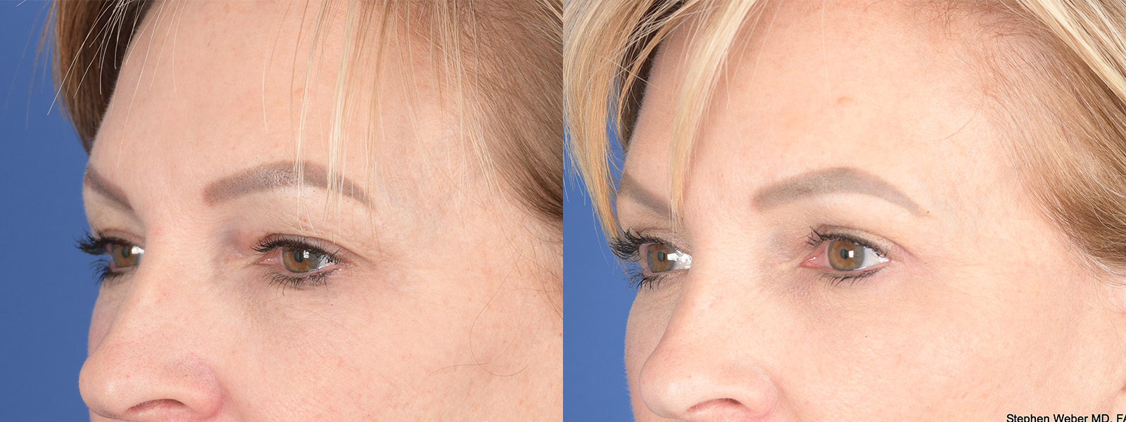 Blepharoplasty Before and After | Weber Facial Plastic Surgery